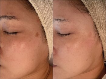 エナン(enan)/シミケア＋ビタミンAC導入6回