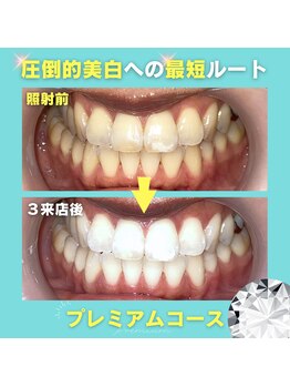 ノママホワイトニング 大宮店/日本最高峰の圧倒的な効果♪