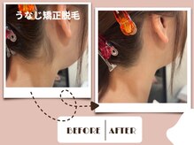 オプス ライフビューティー(OPS×LIFE BEAUTY)/うなじ矯正脱毛