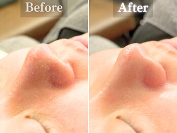 ボーンオム(Born Homme)/毛穴洗浄＋美容液導入：20代女性