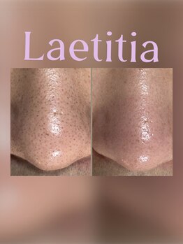 レティティア(Laetitia)/症例9【毛穴吸引&最新パック】