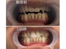 スマイルホワイト/40代男性