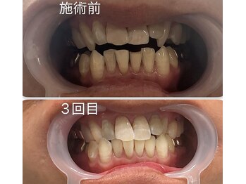 スマイルホワイト/40代男性