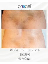 ユミト(Umit)/プロセルフェイシャル