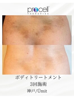 ユミト(Umit)/プロセルフェイシャル