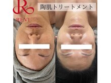 カルナ(CARNA)/陶肌トリートメント★