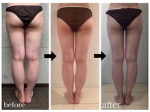 アンドモア(&more)/痩身症例