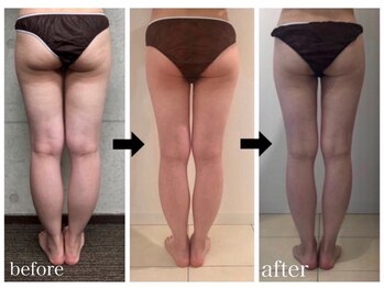 アンドモア(&more)/痩身症例