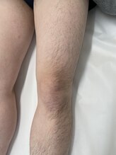 ロイビー(loeyB)/脱毛前