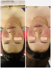 リラキュート(Rela Cute)/光フェイシャル1回目