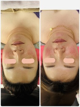 リラキュート(Rela Cute)/光フェイシャル1回目