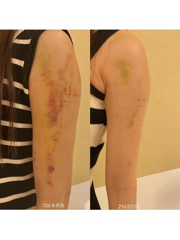 マドモアゼル 麻布十番/上半身インディバ