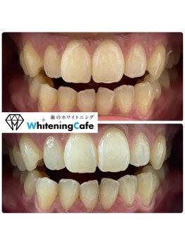 ホワイトニングカフェ 守山店/8回コース症例写真