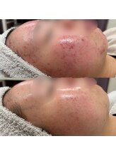 サロンドブランシール(salon de blanchir)/ニキビケアビフォーアフター