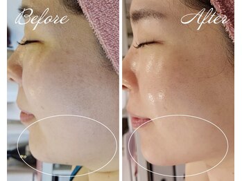 リヨン(Lyon)/小顔・たるみ&リフトアップ専門