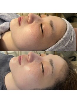 リリアス(RILLIAS)/くすみ・シミケア