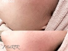 ミュリー(MuRIR)/韓国美肌フェイシャルWax