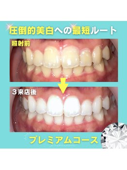 ノママホワイトニング 大宮店/日本最高峰の圧倒的な効果♪