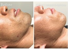 レア(LEA)/ひげ脱毛【Before &nbsp;After】