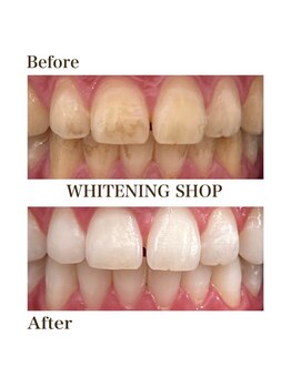whitening shop 守谷店/ホワイトニングショップ守谷店