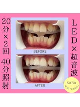 ココティ ホワイトニング(Cocotii)/お客様ビフォーアフター