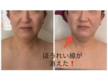 ビパール(bea pull)/40代～ほうれい線、二重アゴ
