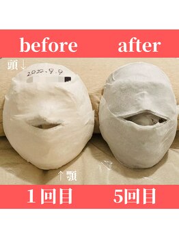 ロータス ビューティー(LOTUS Beauty)/石膏パックビフォーアフター