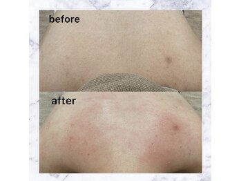 シュバル(CHEVAL)/背中ワックス脱毛♪