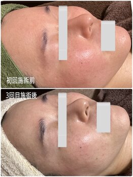 ブライトリー(Brightly)/ハーブ×肌質改善の途中経過!