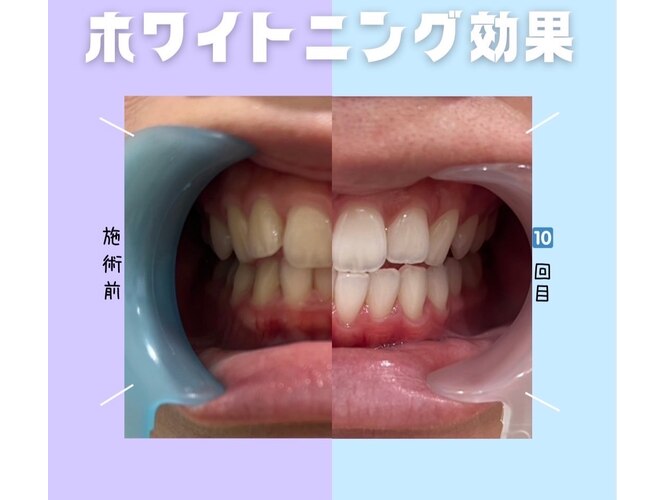 セルフホワイトニング専門店Whitening Club 小松店