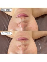 ベルファーム(Belle Femme)/リフトアップならプラズマリフト