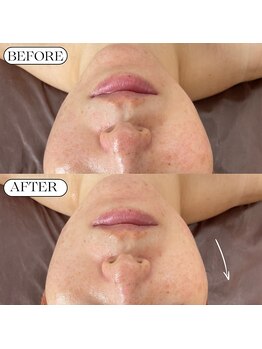 ベルファーム(Belle Femme)/リフトアップならプラズマリフト