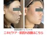 【肌質改善エステ】肌荒れ改善したい方向け/ニキビケア　90分コース