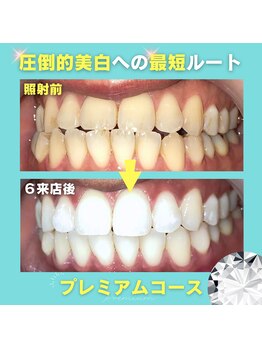 ノママホワイトニング 大宮店/日本最高峰の圧倒的な効果♪