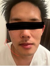 ポマイカイ 名古屋丸の内店(pomaikai)/ハイドロフェイシャル