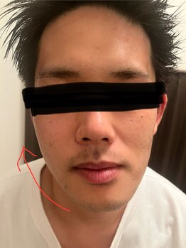 ポマイカイ 名古屋丸の内店(pomaikai)/ハイドロフェイシャル