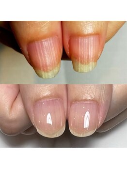 キュア(Cure.)/爪の凹凸でお悩みのお客様ネイル