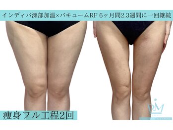 リメイククリニカルビューティー(Remake clinical beauty)/痩身フル工程2回施術