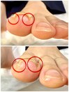 巻き爪矯正しなくても改善