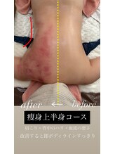 ミミ(MIMI)/背中片面ビフォーアフター