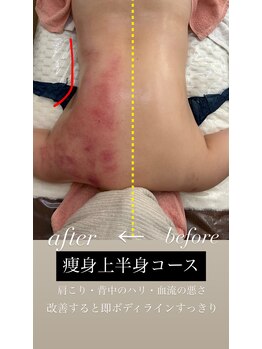 ミミ(MIMI)/背中片面ビフォーアフター