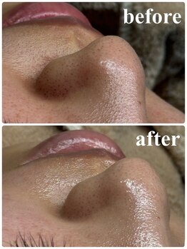 ビズエー(viz.A)/ワックス+ハーブピーリング