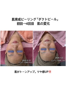 リエル(Liel)/ダクトピールで肌質改善　