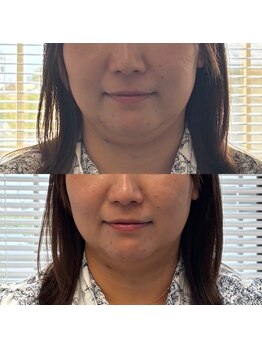 チェックミー(Check me)の写真/期間限定で自信あふれる毎日を。この夏あご下をすっきり整えて理想の自分へ導く！