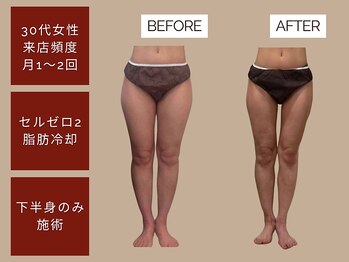 ベベティー(BEBETIE)の写真/【感動の美脚】速攻脂肪燃焼ケア♪頑固なぼこぼこ太ももを分解＆燃焼して、キュッと引き締まった美脚へ☆