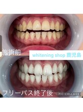 ホワイトニングショップ 鹿児島店/#鹿児島ホワイトニング
