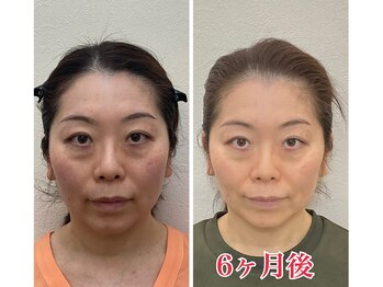 小顔22 ボルティ 赤坂支店(Bolty)/小顔シンメトリー矯正＆全身矯正