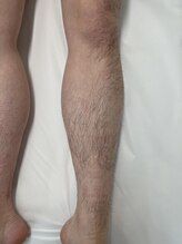 ロイビー(loeyB)/脱毛前