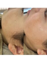 スイ 四条烏丸(SUI)/頬の毛