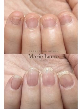 マリーロール 天王寺店(Marie Laure)/自爪育成/深爪矯正/ネイルケア